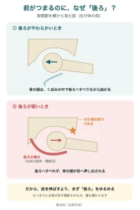 股関節を曲げると骨の頭は後ろへすべる。後ろが硬いと前へ押し出され、付け根の前でつまる模式図