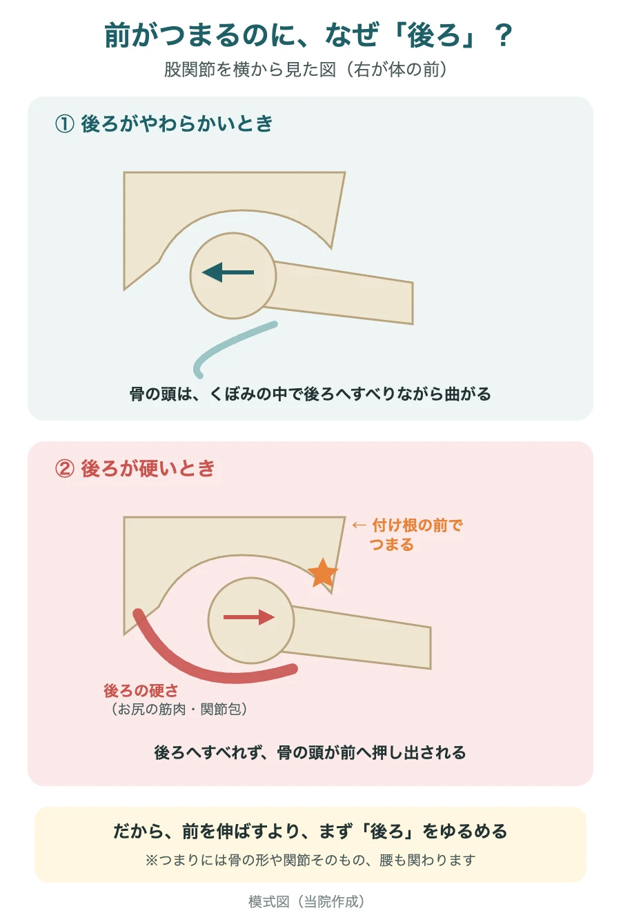 股関節を曲げると骨の頭は後ろへすべる。後ろが硬いと前へ押し出され、付け根の前でつまる模式図