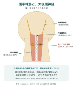 頭半棘筋と、筋肉を貫いて後頭部へ向かう大後頭神経の模式図（後ろから見た図）