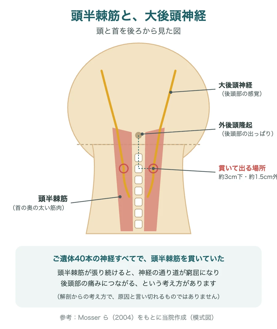 頭半棘筋と、筋肉を貫いて後頭部へ向かう大後頭神経の模式図（後ろから見た図）