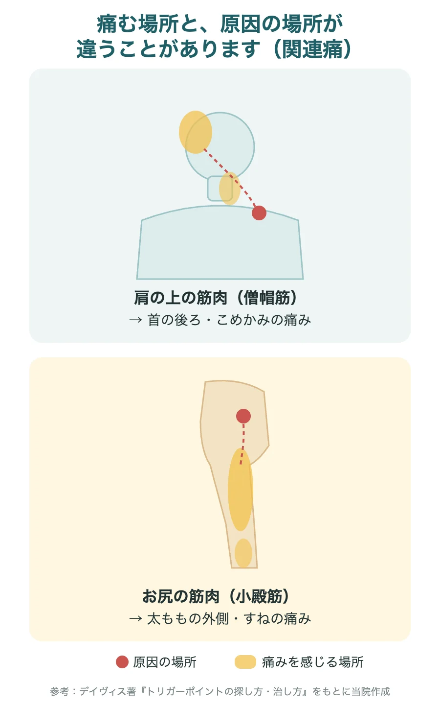 関連痛の例(肩の上の筋肉から首の後ろ・こめかみへ、お尻の筋肉から太ももの外側・すねへ)のイラスト