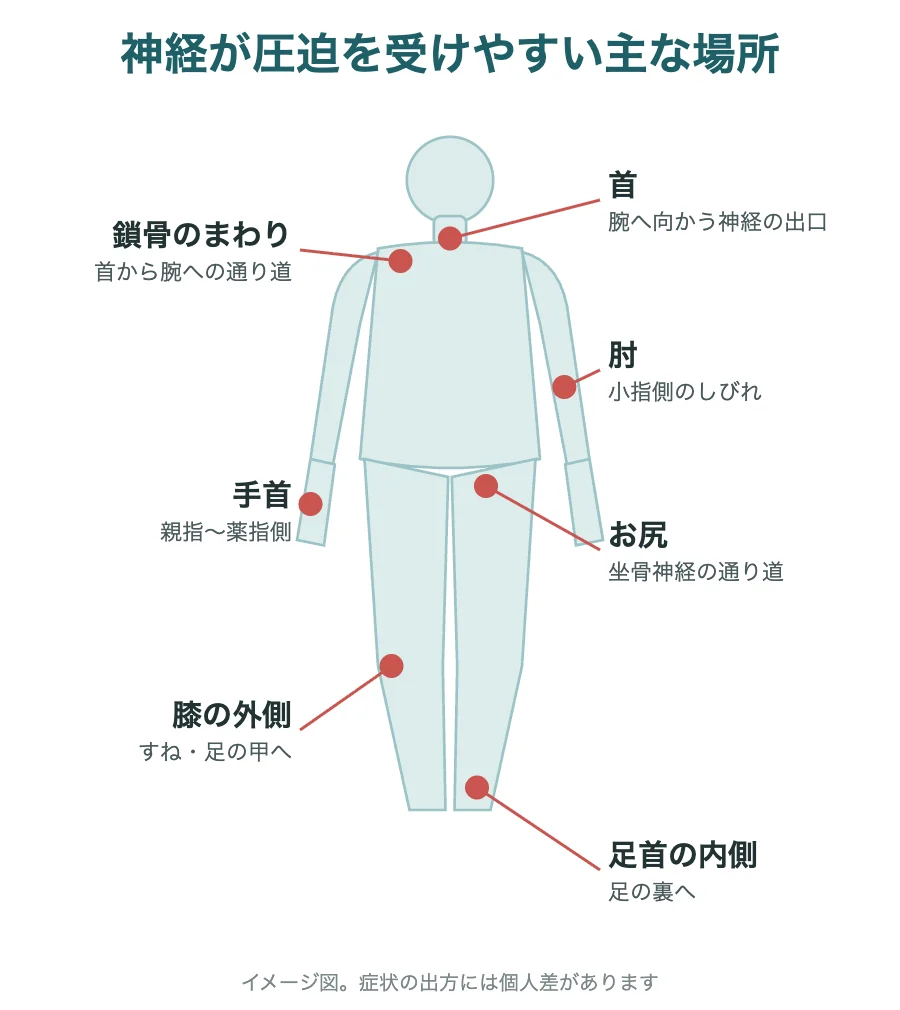神経が圧迫を受けやすい主な場所(首・鎖骨のまわり・肘・手首・お尻・膝の外側・足首の内側)のイラスト