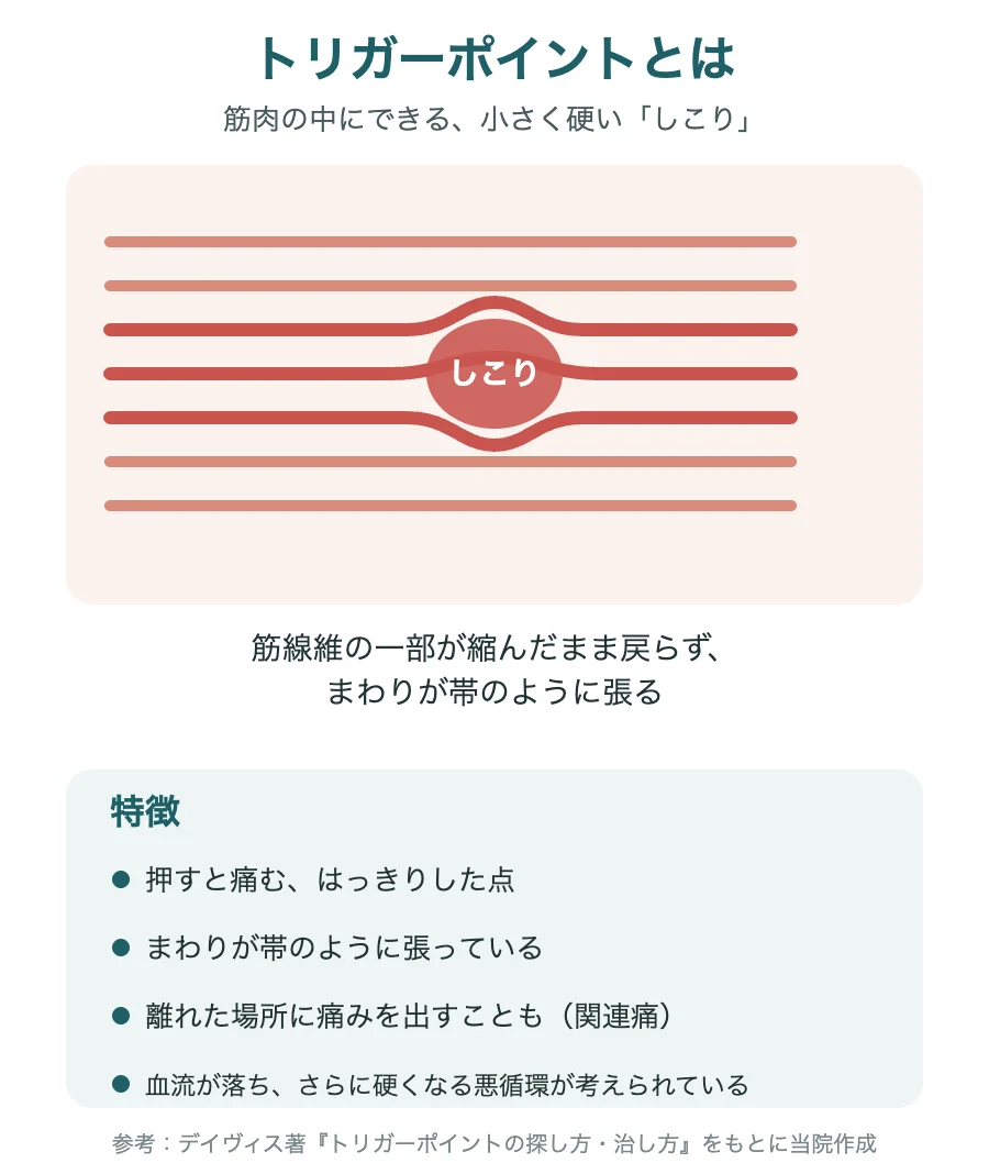 トリガーポイント(筋肉の中の小さく硬いしこり)の特徴を示すイラスト
